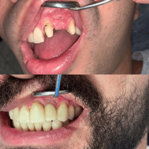 implantes2