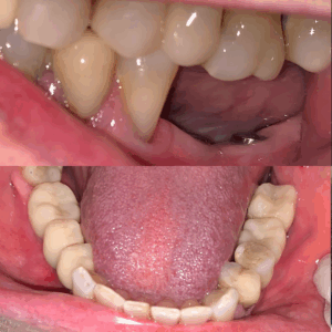 implantes3